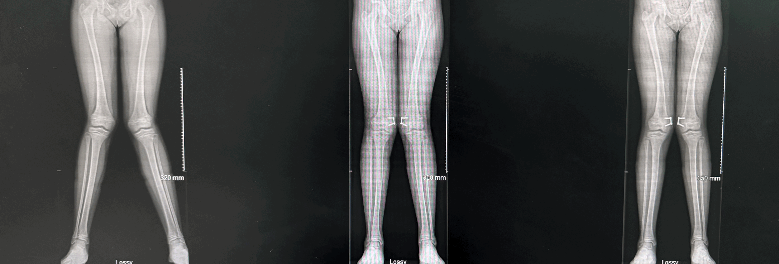 Early Osteoarthritis: How to Intervene Before Joint Collapse (2026)