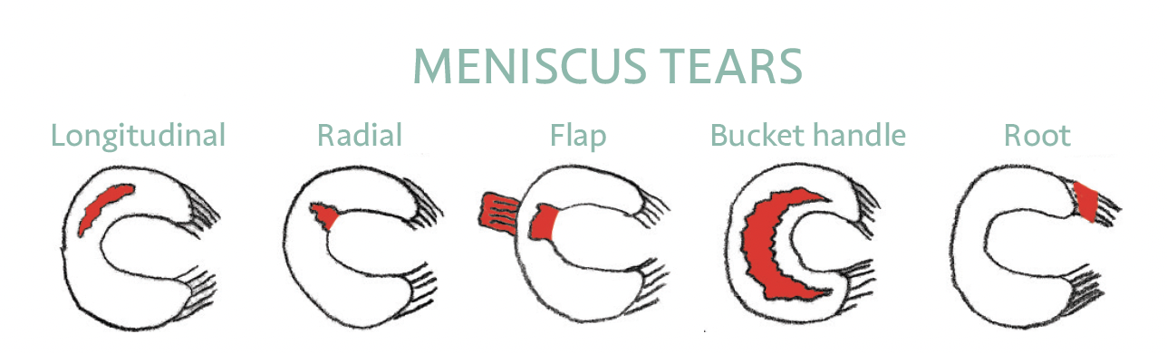 Current Thinking on Meniscus Tears