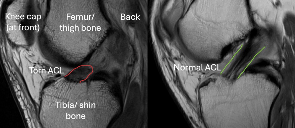 Why ACL Surgery Sometimes Fails: Causes, Prevention and Revision Strategy (2026)
