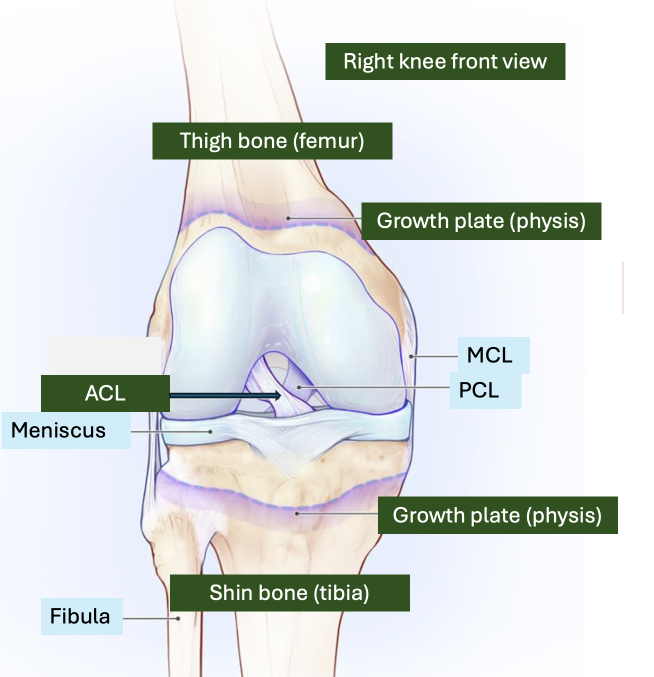 Anterior cruciate ligament injuries in children and adolescents
