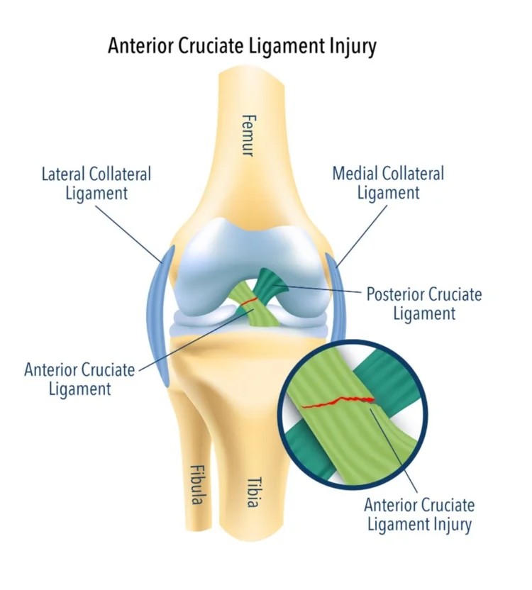 ACL injuries.
