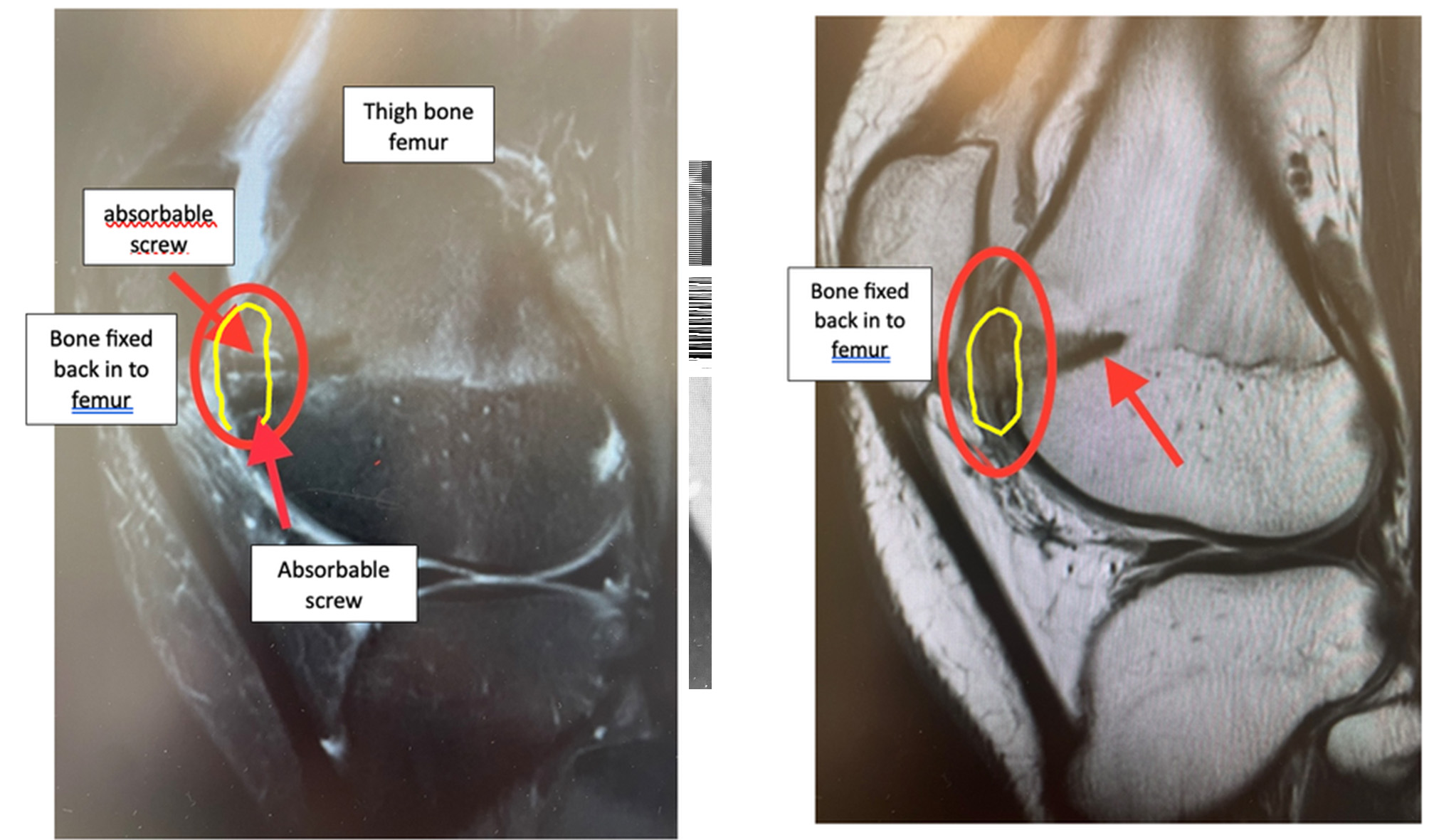 MRI scan after bone fixed back