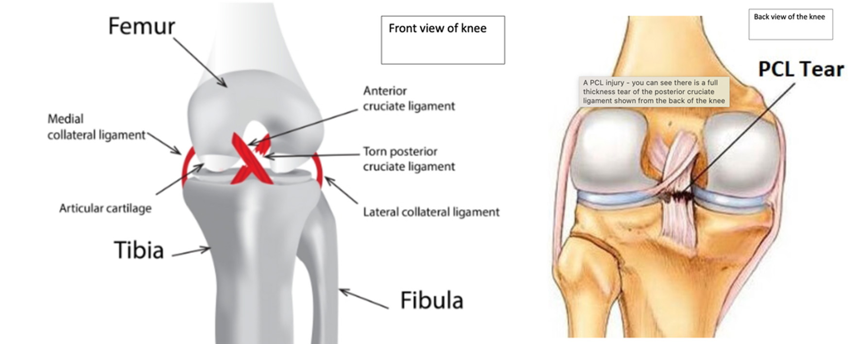 Posterior cruciate ligament PCL injuries