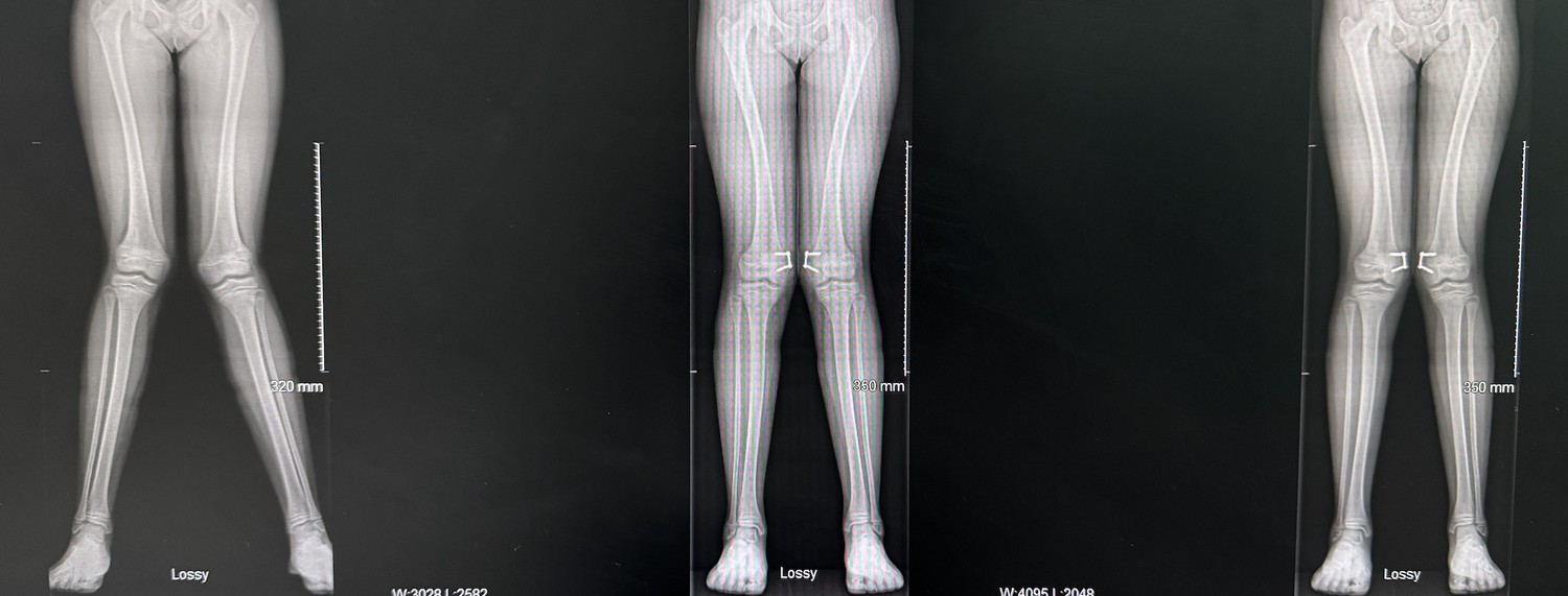 Genu valgum or knock knees