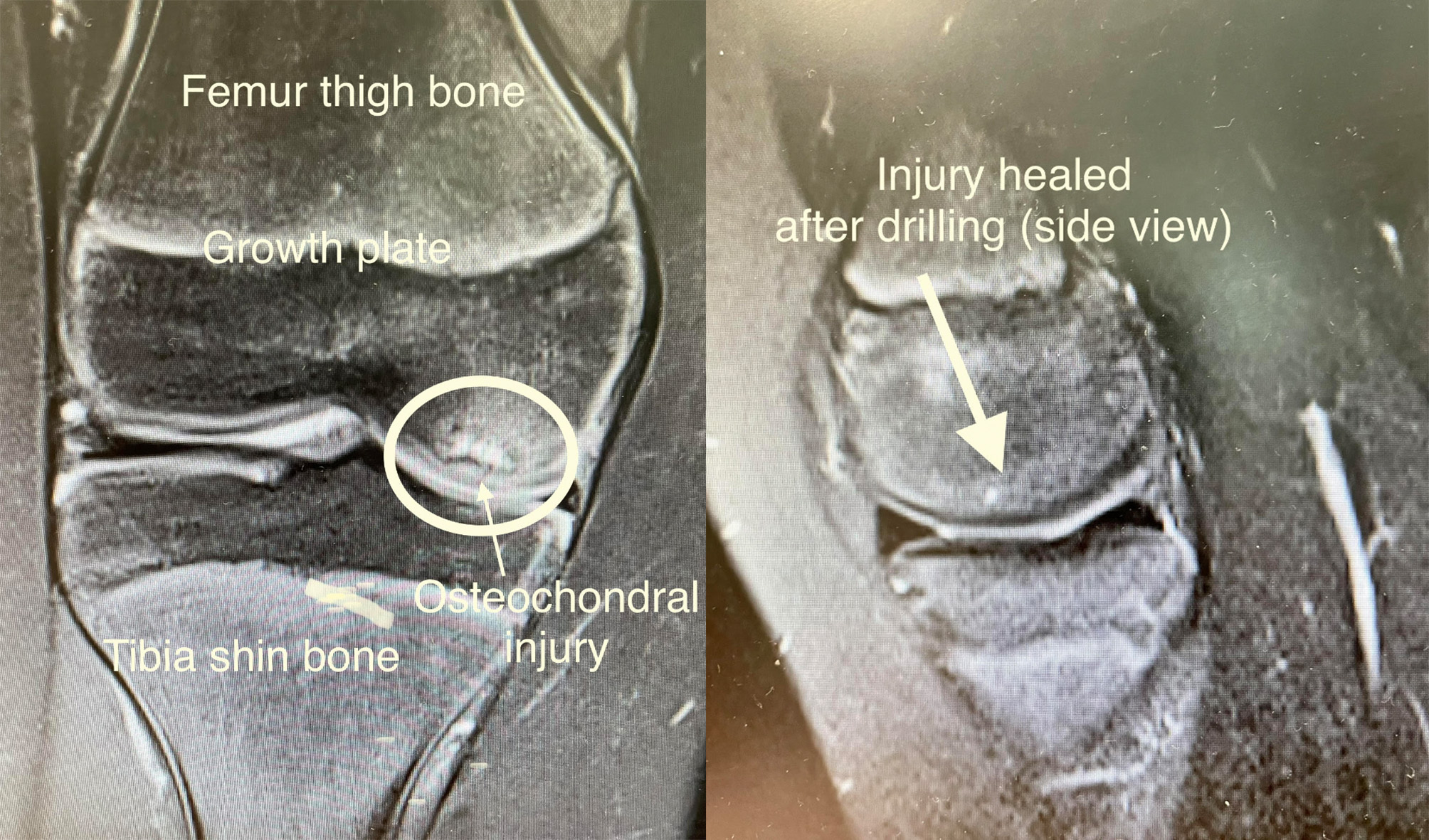 Osteochondral injuries of the knee (osteochondritis dissecans)
