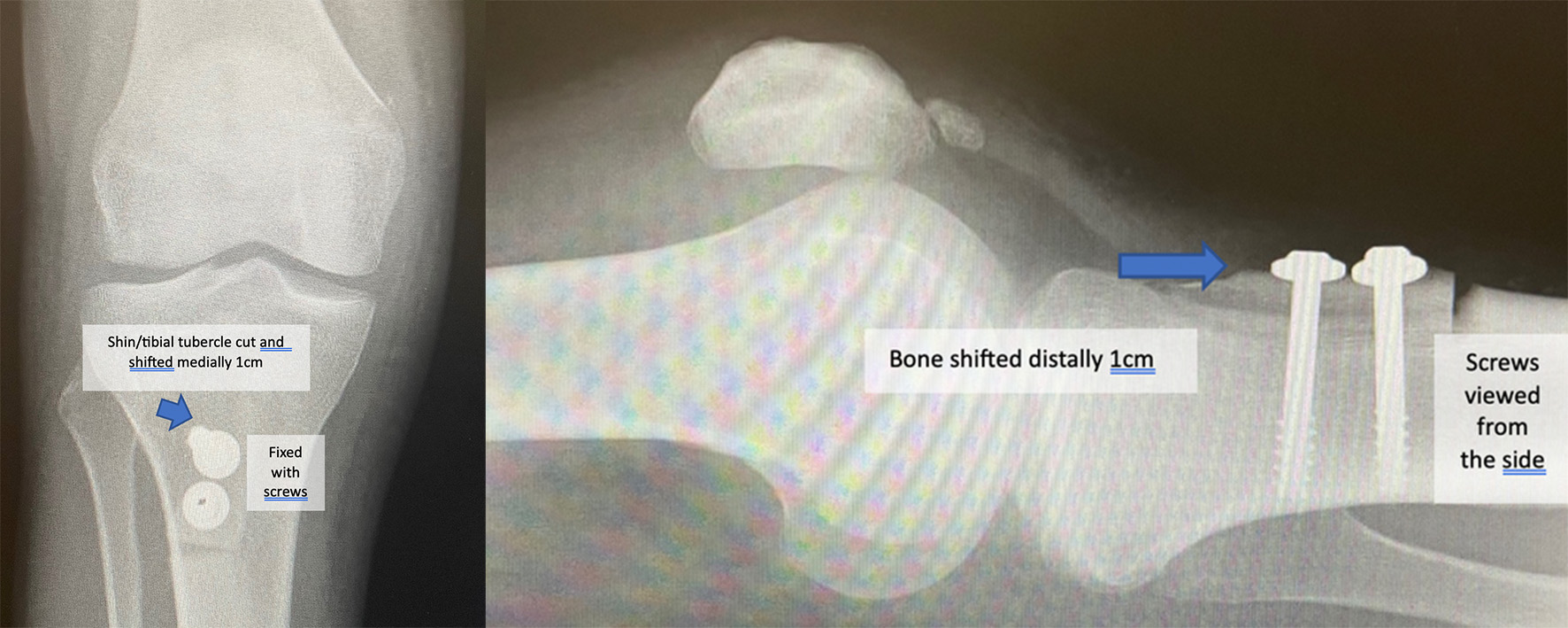 What is tibial tubercle transfer osteotomy (bony realignment)?