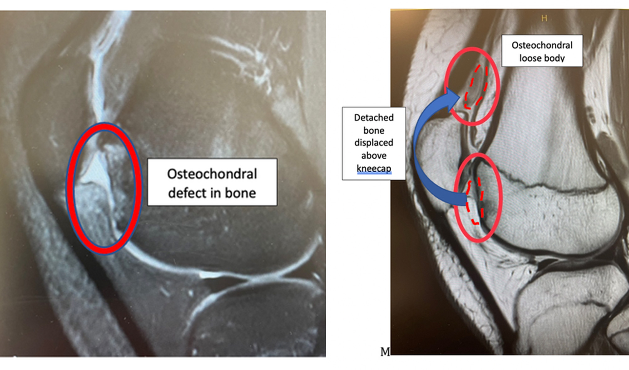 An osteochondral injury