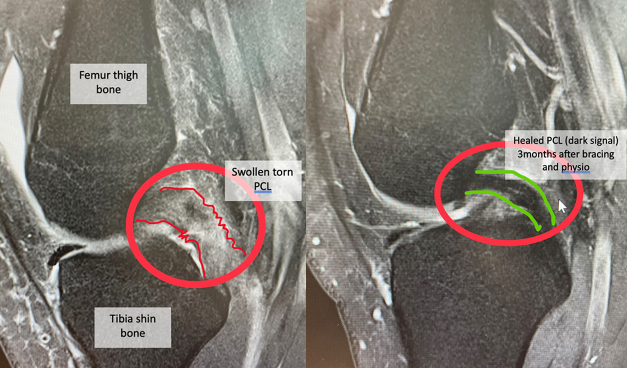 Causes and Types of PCL Injuries
