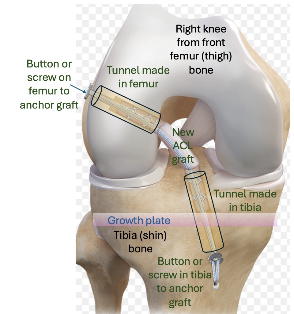 How do you replace the damaged ACL?