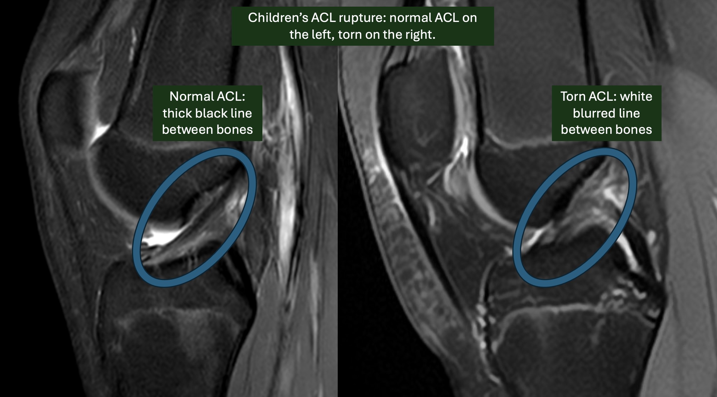 What does a kid’s ACL injury look like on MRI scan?