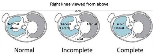 What is Discoid Lateral Meniscus?