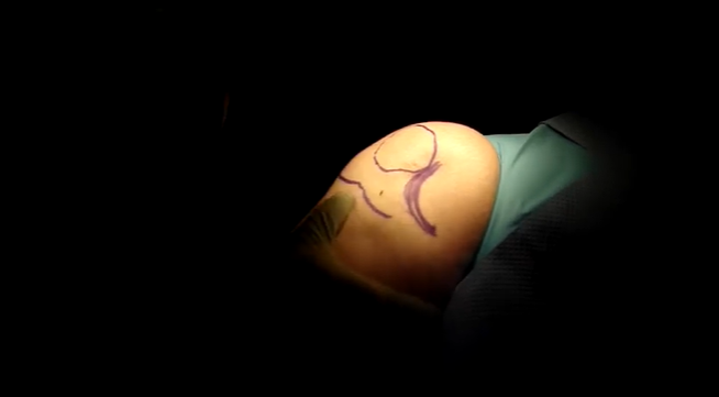 What are the stages of doing a knee arthroscopy?