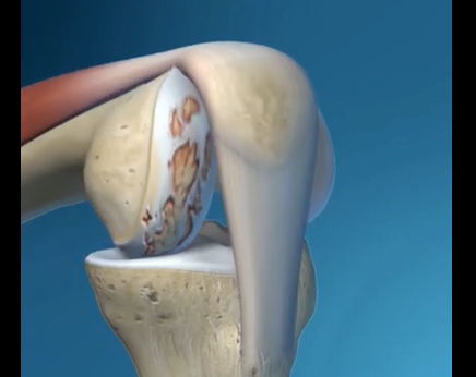 MAKO unicompartmental knee resurfacing