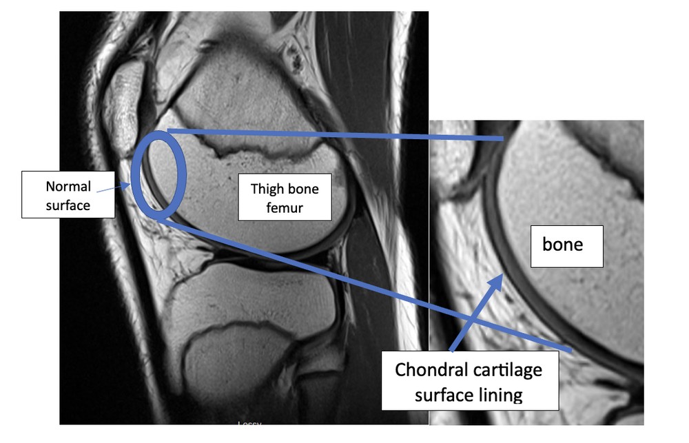 Osteochondral injury/ fracture