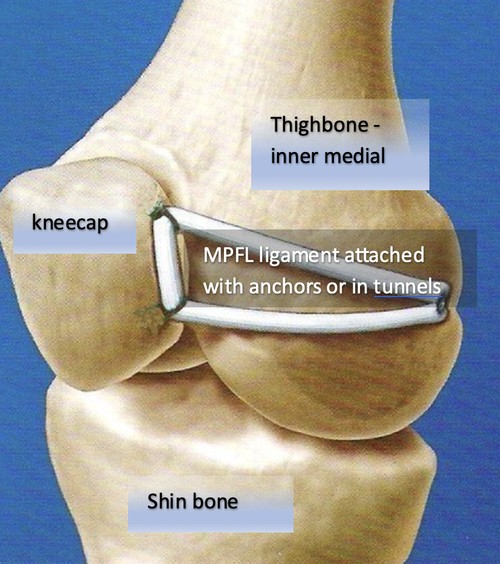 What is Medial Patellofemoral reconstruction/MPFL reconstruction?