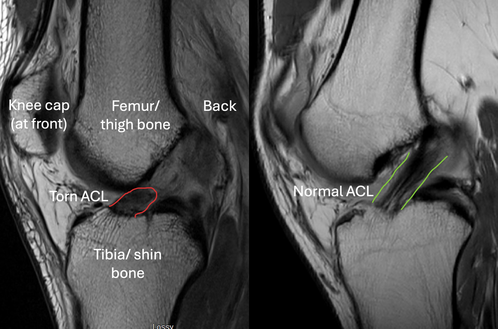 What does a torn ACL look like on MRI scan?