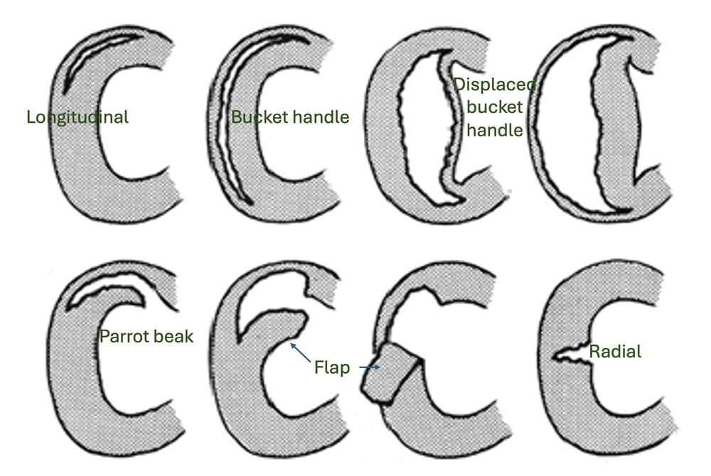 What are the different types of meniscus tear?