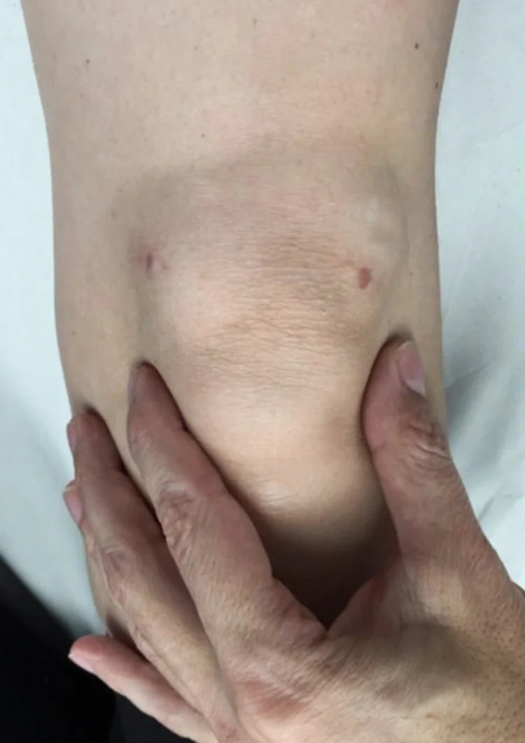 What does a knee arthroscopy scar look like?