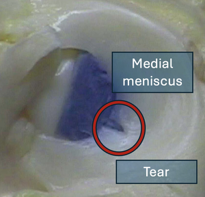 How do you tear a meniscus?