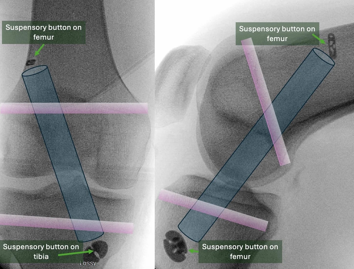 ACL reconstruction