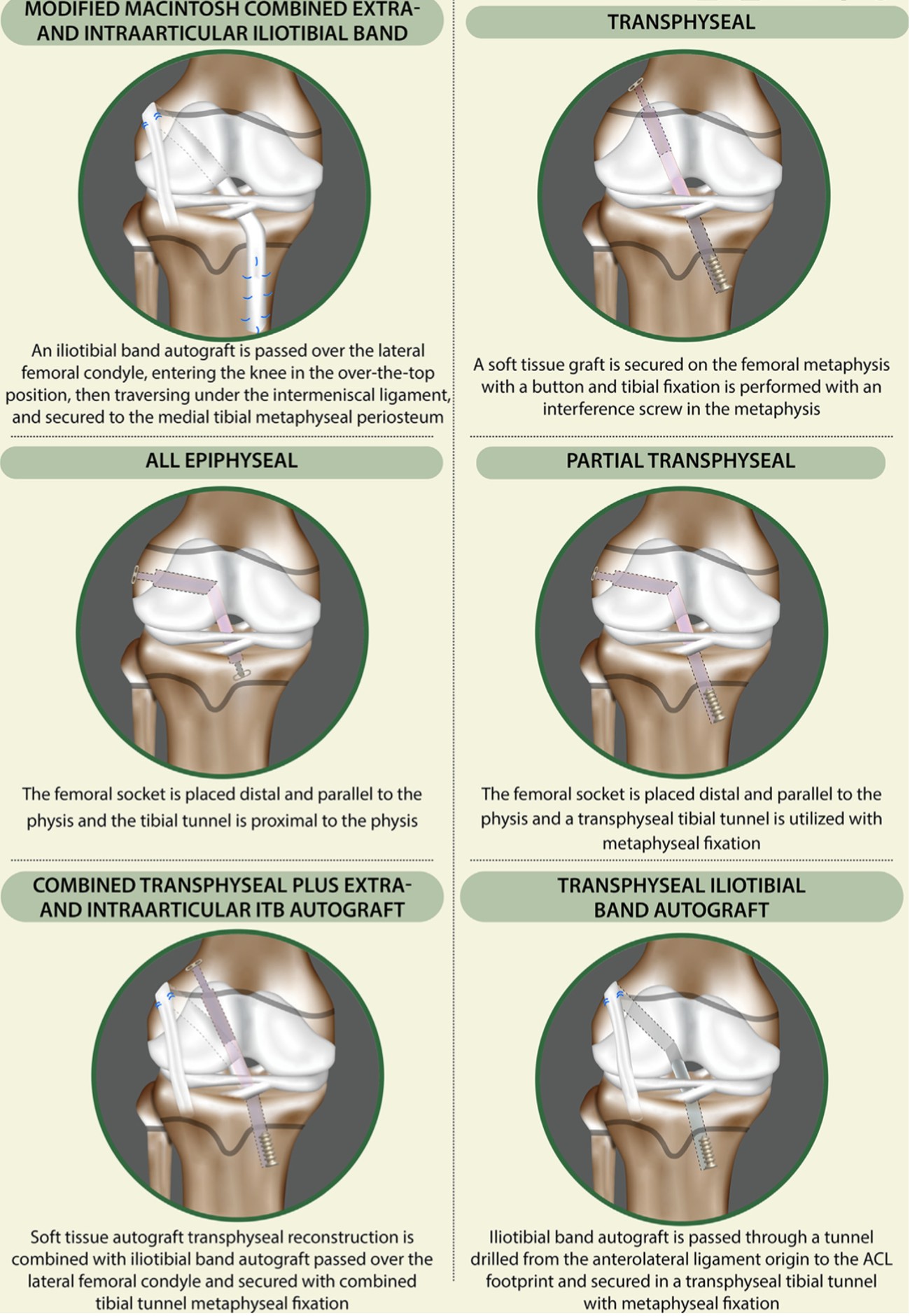 Which are the different techniques for paediatric ACL reconstruction?
