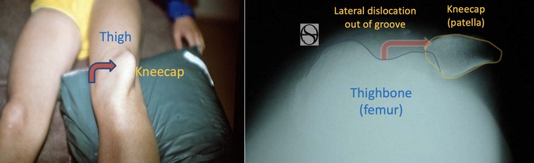What is a dislocating kneecap, or patellofemoral instability?