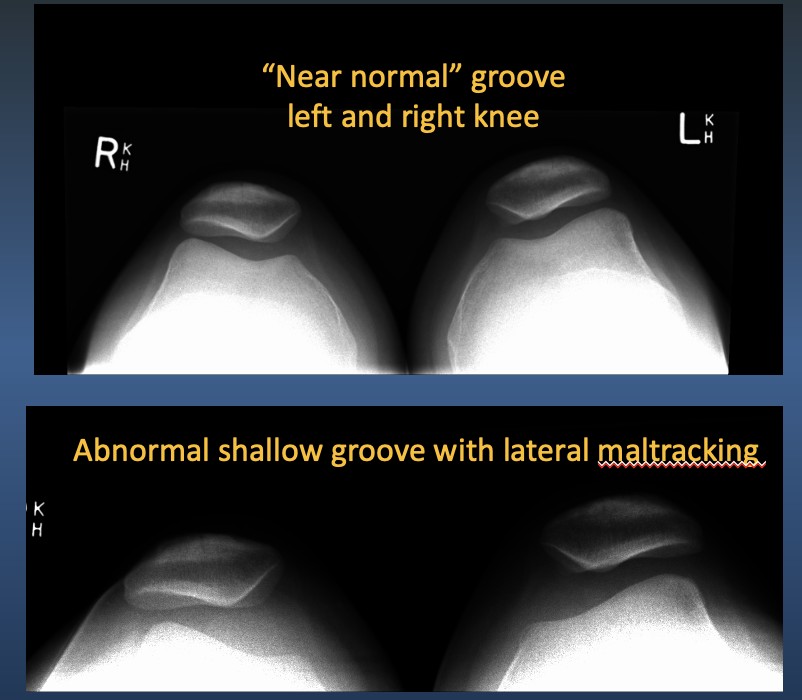 What tests/investigations for a dislocating kneecap?