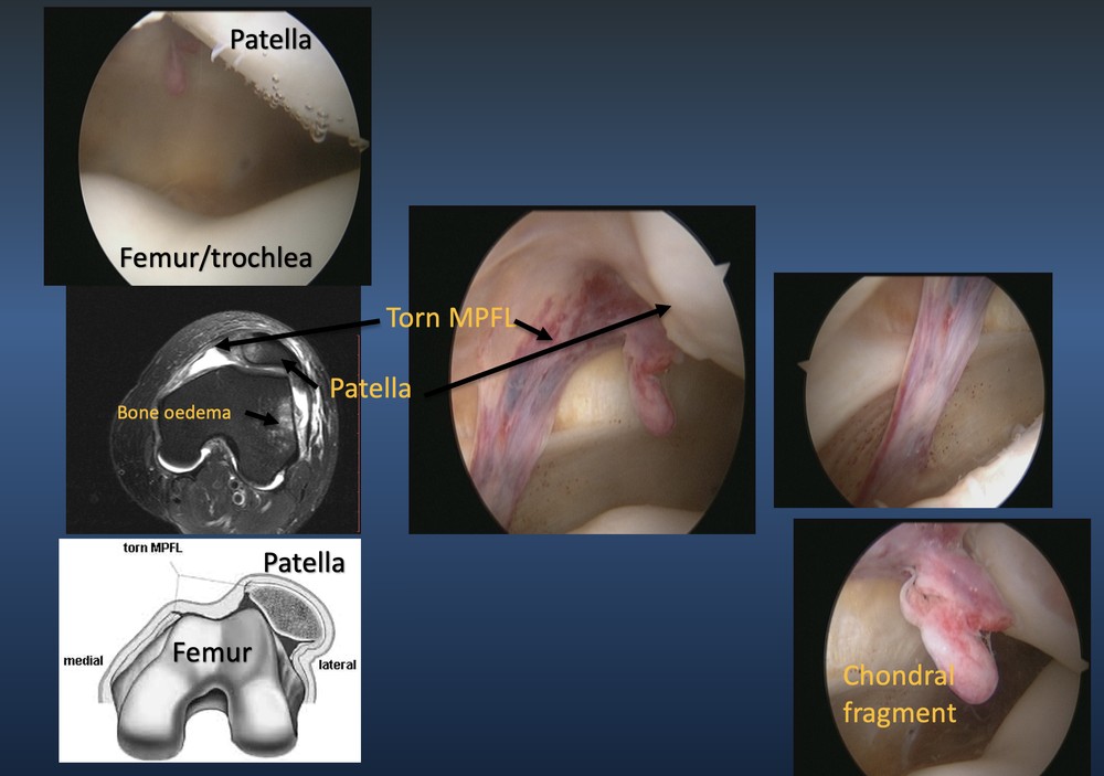 What does  a torn MPFL look like?