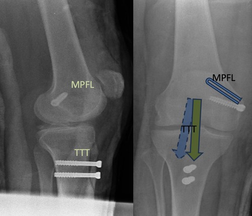 Can you have MPFL reconstruction and tibial tubercle transfer together?