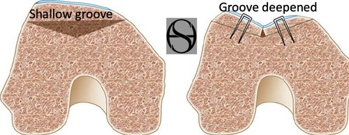 What is trochleoplasty?