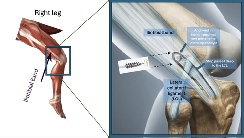 What is a lateral tenodesis reinforcement and why might it be used?