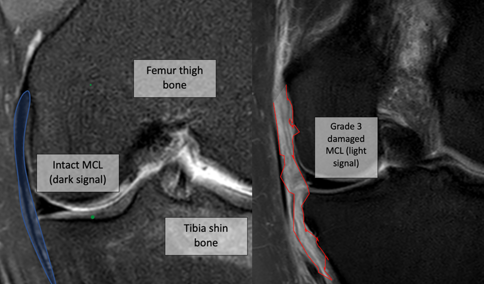 Medial Collateral ligament injuries