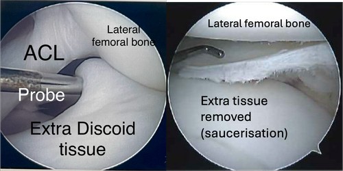 How do you diagnose discoid lateral meniscus?