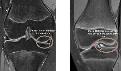 When is surgery required for discoid lateral meniscus?