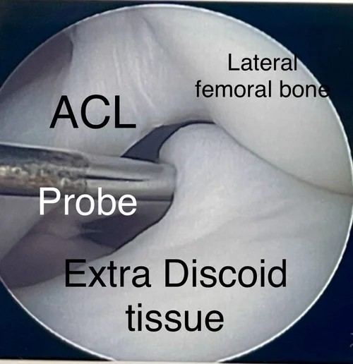 What does surgery for discoid lateral meniscus involve?